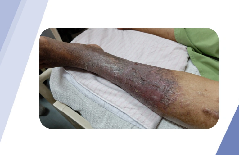 acute_limb_ischemia_content_image